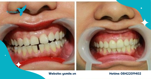 Trám Răng Thẩm Mỹ