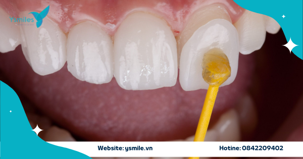 Răng sứ thẩm mỹ