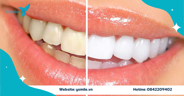 Tẩy Trắng Răng